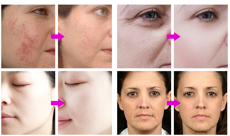 7 Colors PDT Facial Skin Rejuvenation LED Mask - Effect