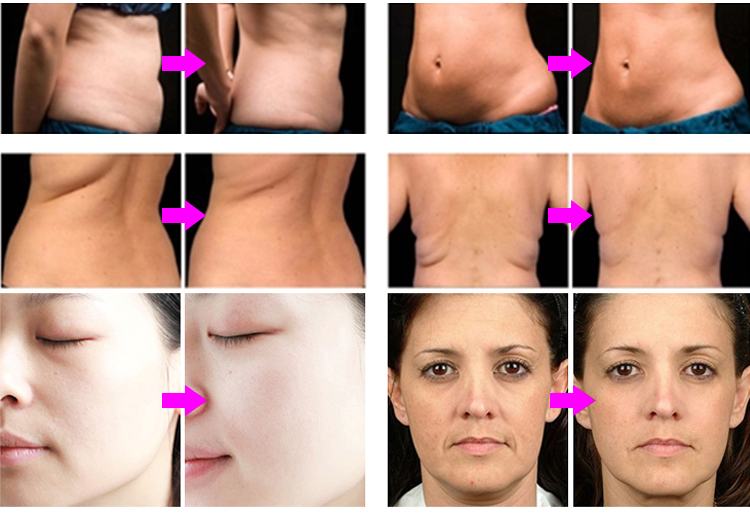 Fat Reducing Skin Rejuvenation Monopole RF Body Slimming Machine - Effects