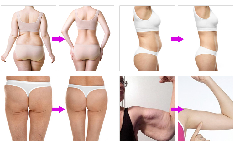 40K Ultrasound Cavitation Fat Blasting Body Slimming Machine - Before & After