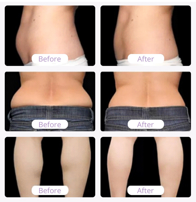 40K Cavitation 3.0 Vacuum 5 in1 Body Slimming Machine - Before & After